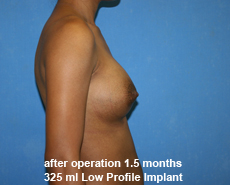 plastic-surgery-breast-augmentation